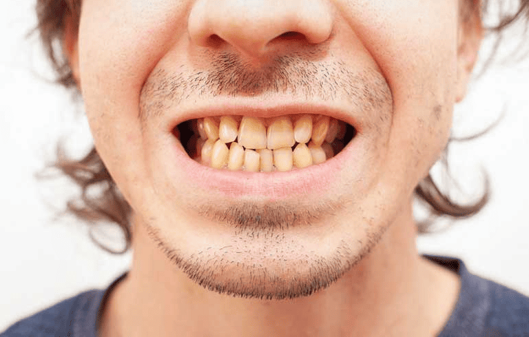 Răng ố vàng có nguy hiểm không? Sự thật ít ai ngờ tới