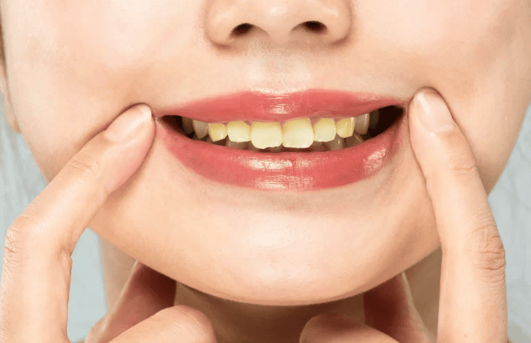 Răng ố vàng khiến bạn kém duyên? Cách khắc phục siêu đơn giản!